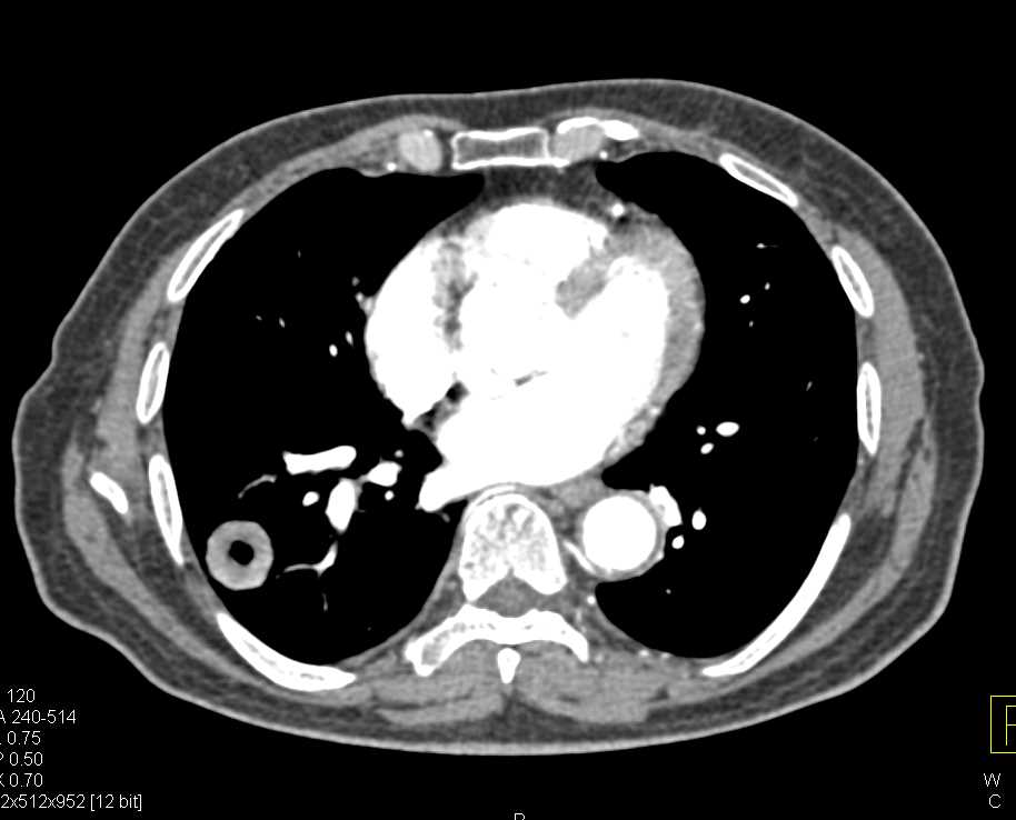 Recurrent Bladder Cancer with Bone Involvement and Lung Metastases - CTisus CT Scan