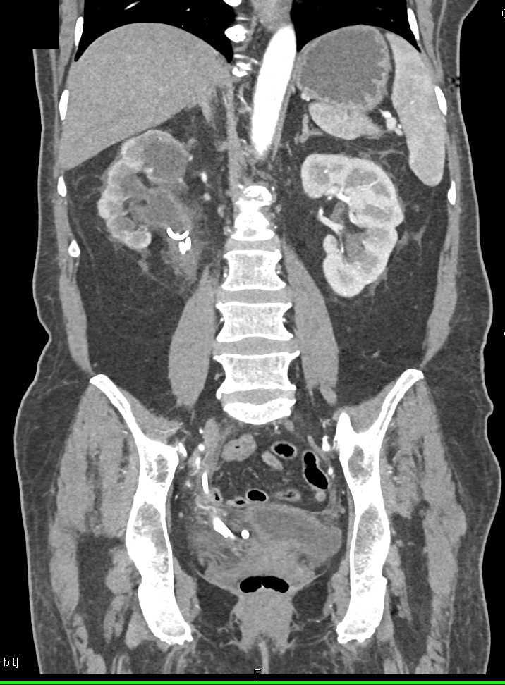 Transitional Cell Carcinoma of the Distal Right Ureter - CTisus CT Scan