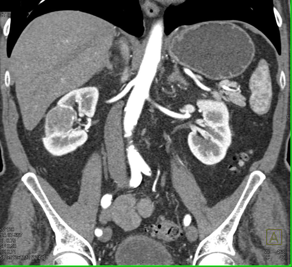 Cystic Right Renal Cell Carcinoma - CTisus CT Scan