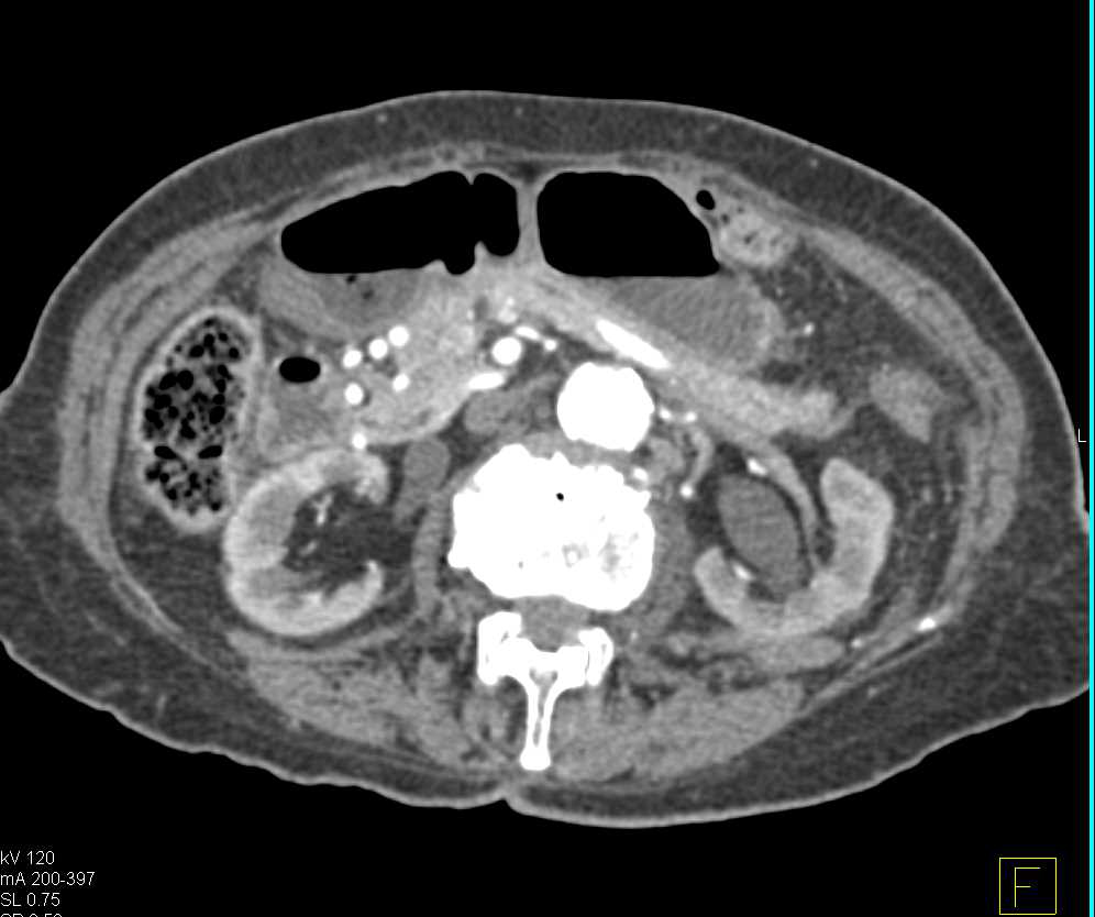 Carcinoma Left Bladder Wall Obstructing the Left Kidney - CTisus CT Scan