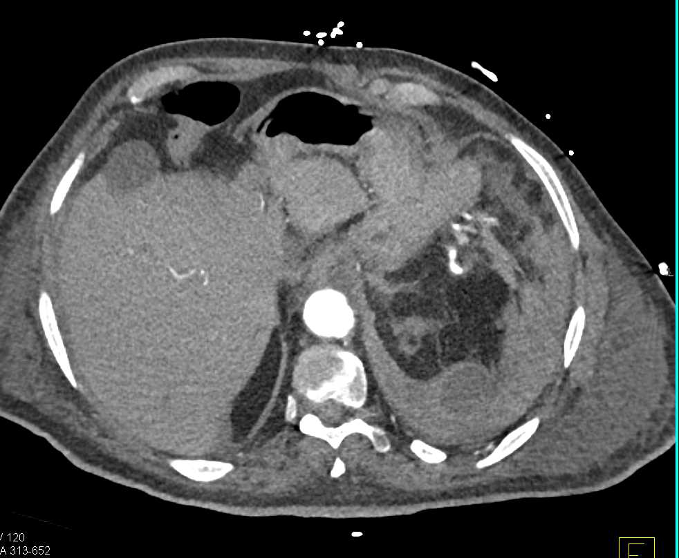 Large Left Retroperitoneal Bleed Involves Left Psoas Muscle - CTisus CT Scan