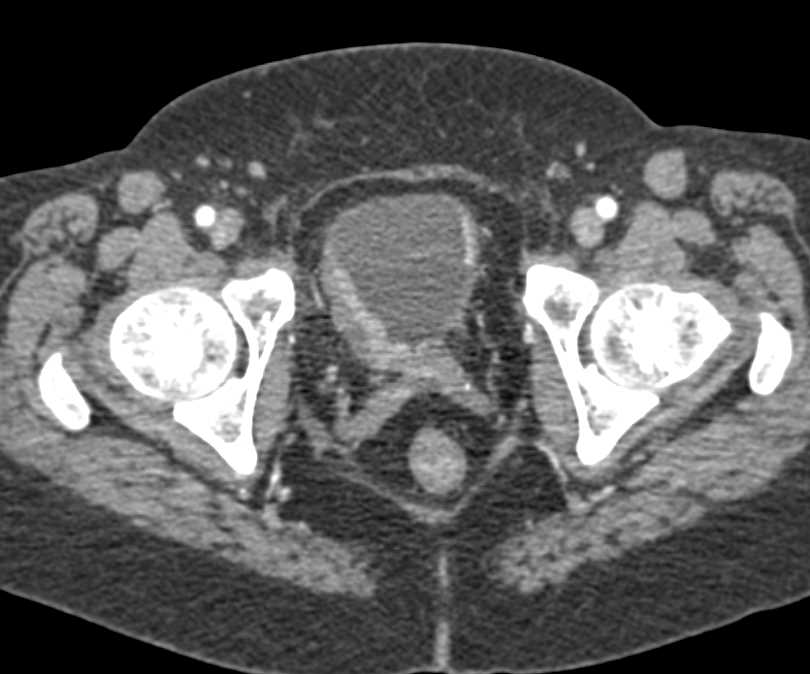 Infiltrating Bladder Cancer in Right Wall of Bladder - CTisus CT Scan