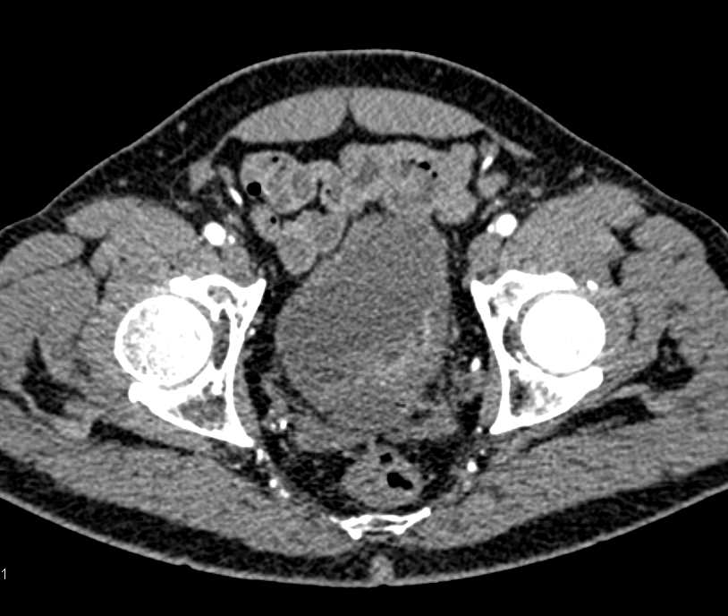 Bladder Cancer at 4 Oclock on Multiple Images - CTisus CT Scan