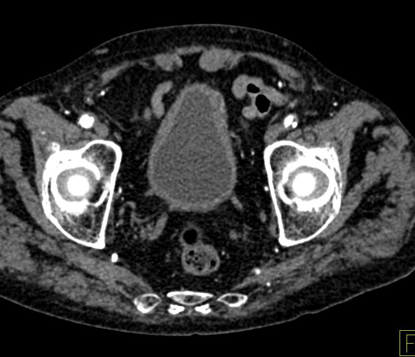 Subtle Bladder Cancer at 2 O'clock - CTisus CT Scan