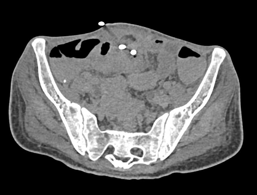 CT Urography with Contracted Bladder and Leak - CTisus CT Scan