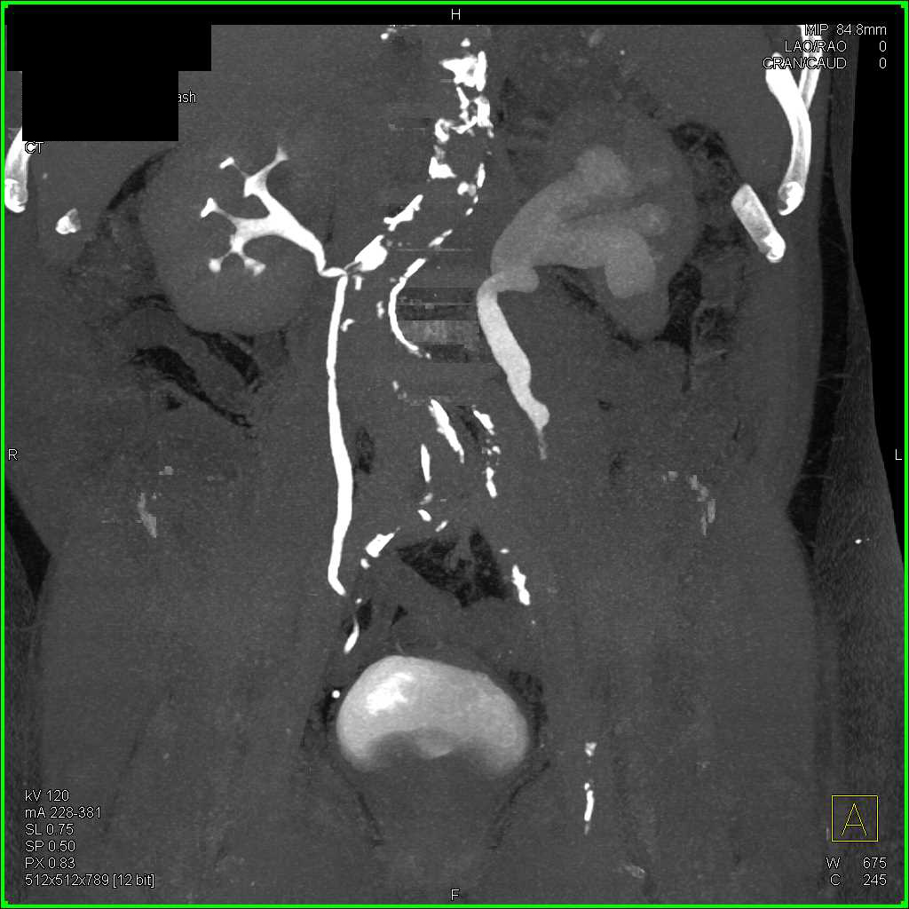 Transitional Cell Carcinoma Left Ureter - CTisus CT Scan