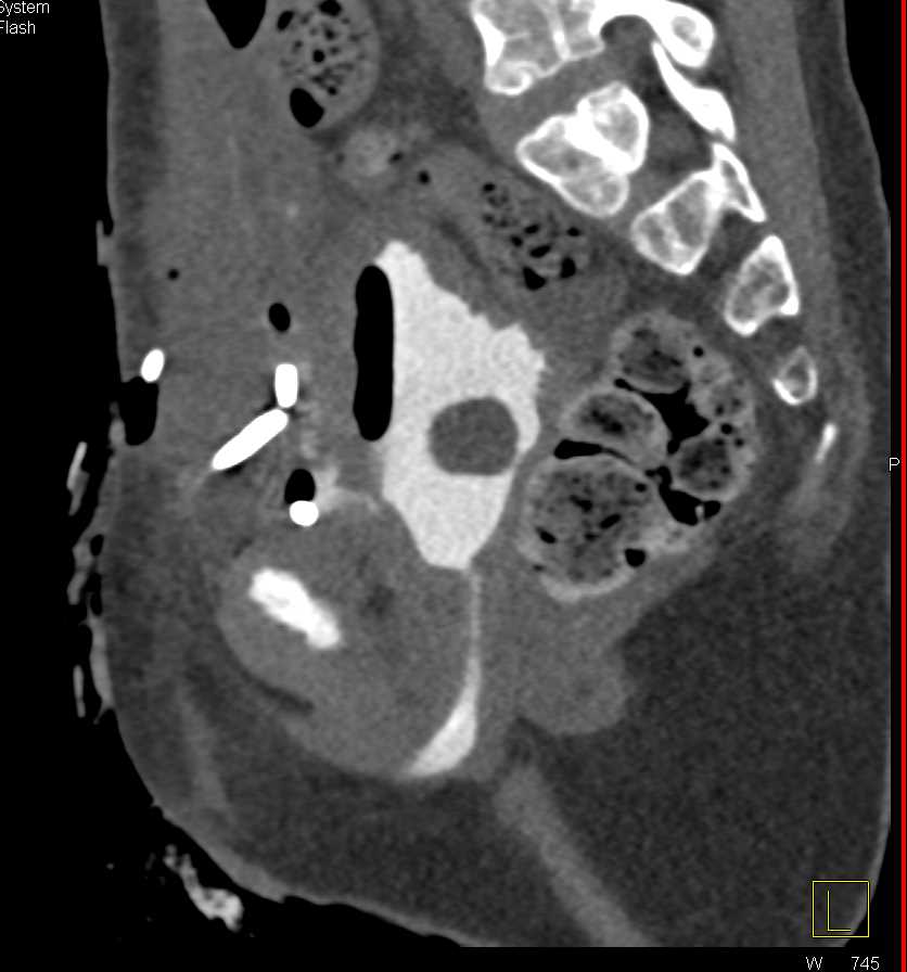 CT Cystogram with Contrast Extravasation - CTisus CT Scan