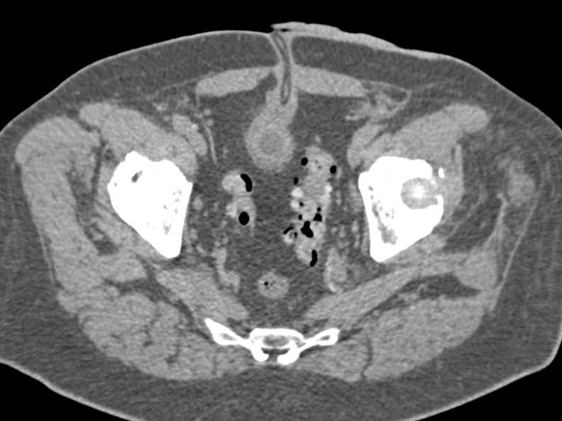 Seeds for Treatment of Prostate Cancer - CTisus CT Scan