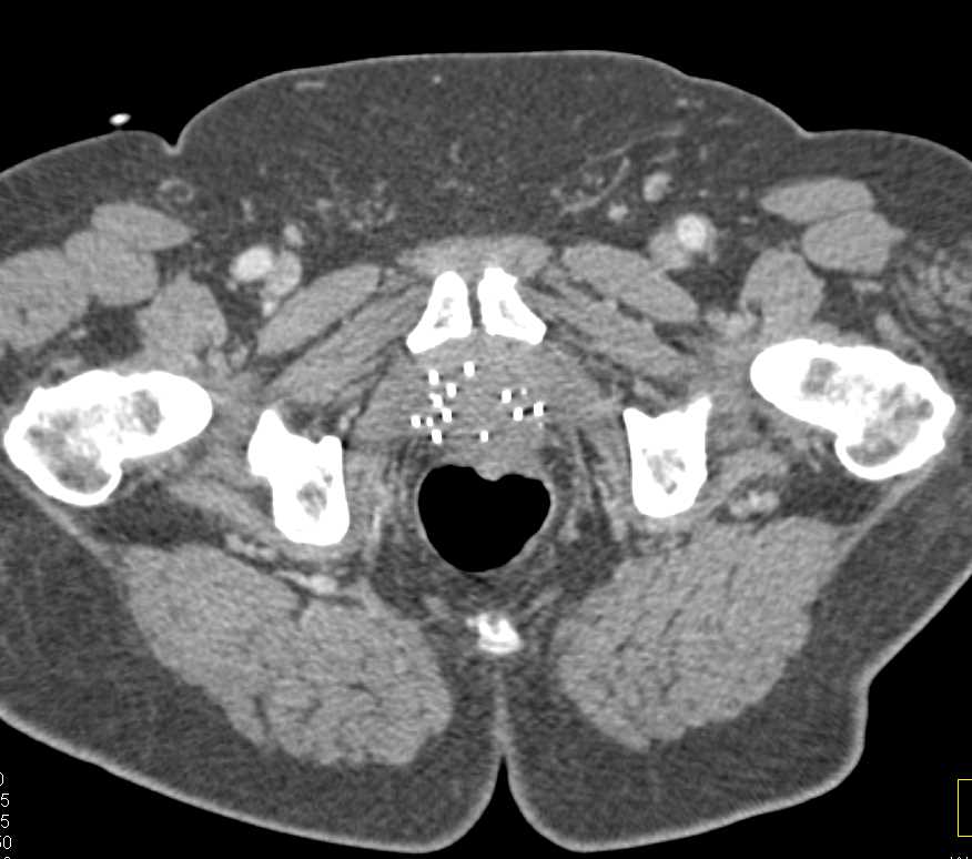 Prostate Cancer with Radioactive Seeds in the Prostate - CTisus CT Scan