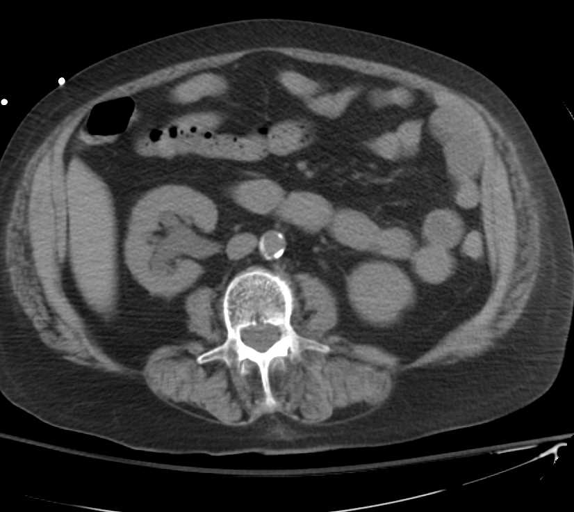 Right Hydronephrosis due to Large Bladder Diverticulum - CTisus CT Scan