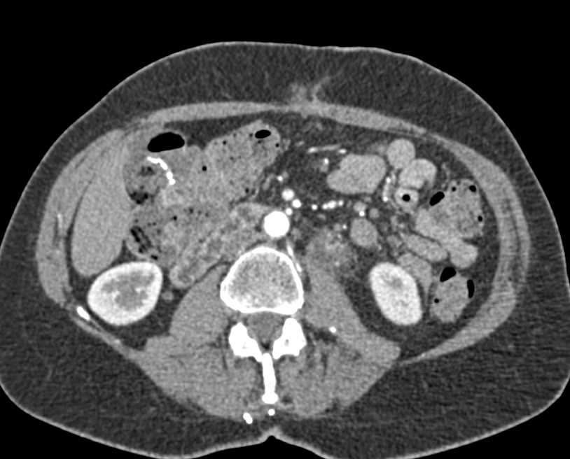 Necrotic Nodes Near Left Renal Hilum - CTisus CT Scan