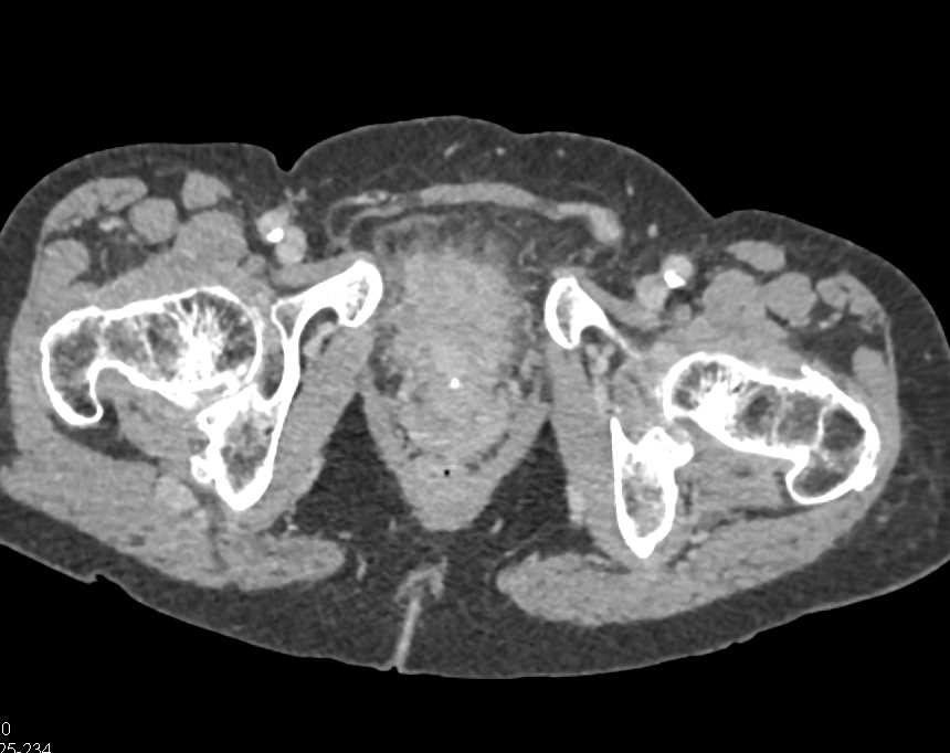 Transitional Cell Cancer (TCC) of the Base of the Bladder - CTisus CT Scan