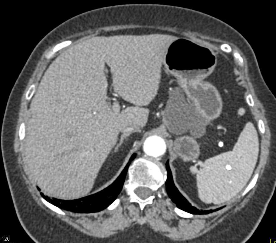 Transitional Cell Carcinoma Left Ureter - CTisus CT Scan
