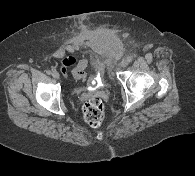 Local Tumor Recurrence Left Lower Quadrant - CTisus CT Scan