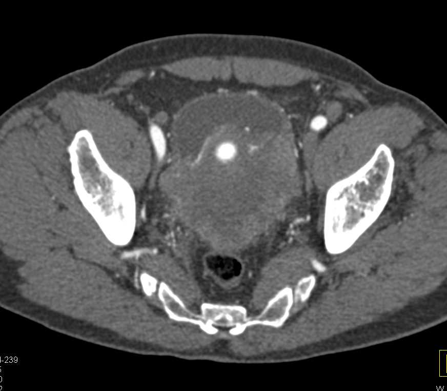 Large Bladder Stone and Chronic Cystitis - CTisus CT Scan