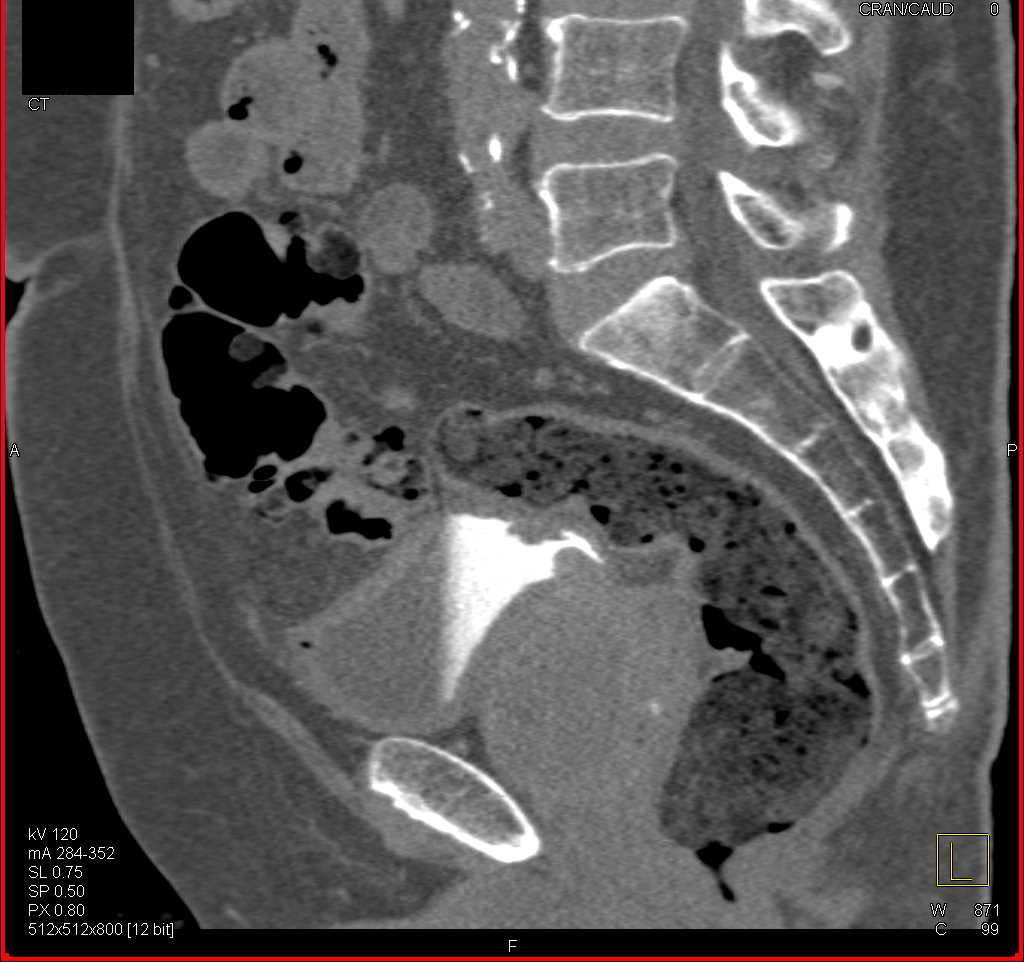 Prostate Cancer Invades Base of Bladder - CTisus CT Scan