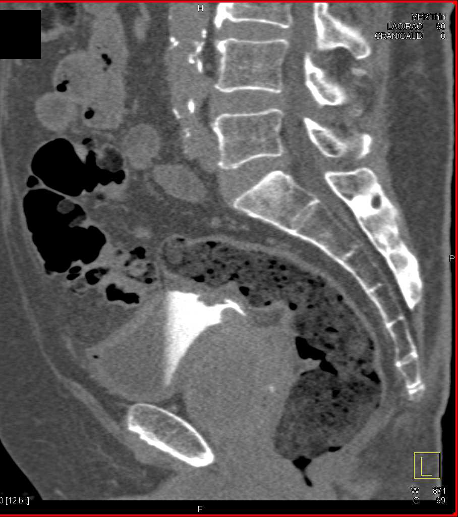 Prostate Cancer Invades Base of Bladder - Genitourinary Case Studies