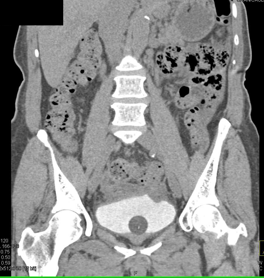 Bladder Cancer with Foley Catheter - CTisus CT Scan