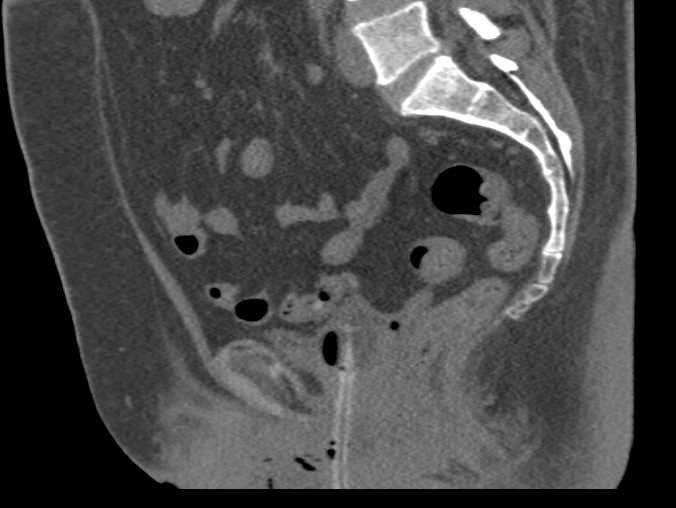CT Cystogram With Fistulae to the Cervix Seen Best on Sagittal Views - CTisus CT Scan