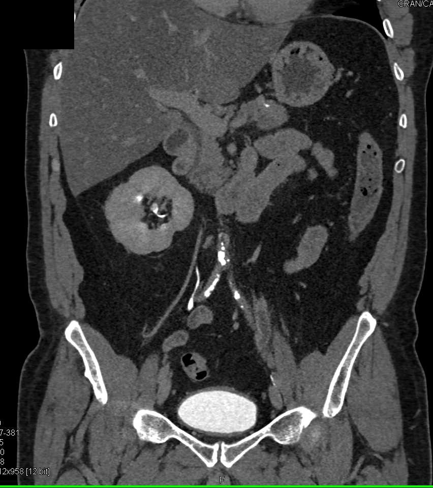 Transitional Cell Carcinoma of the Proximal Left Ureter - CTisus CT Scan