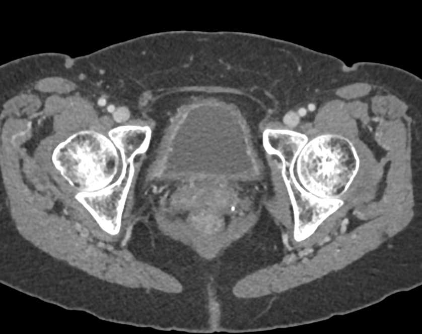 Incidental Bladder Cancer - CTisus CT Scan