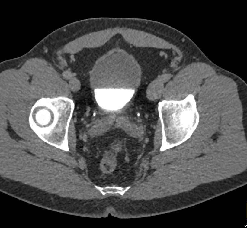 Minimal Fat in the Bladder Wall - CTisus CT Scan