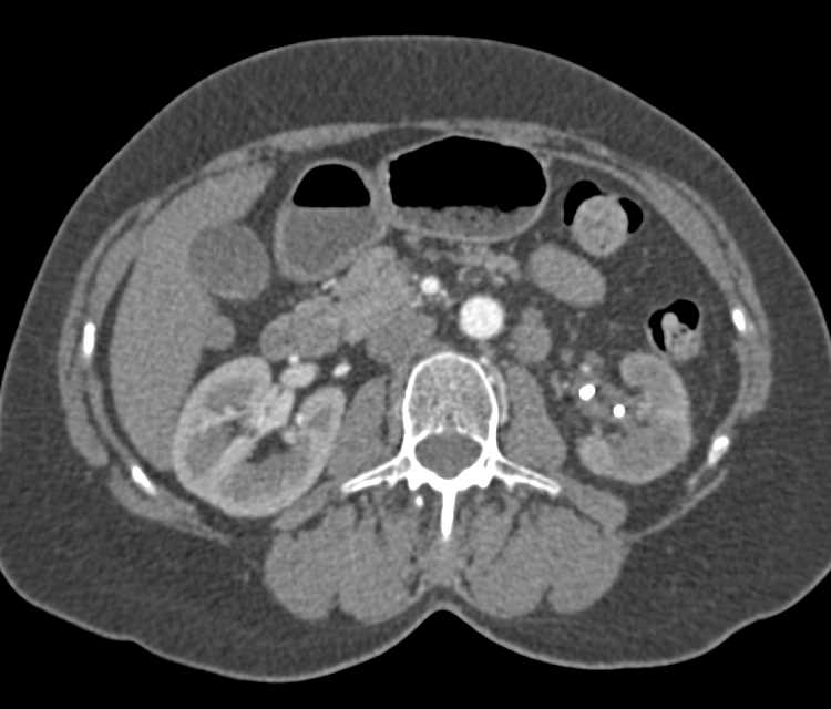 Bladder Cancer at the Left Ureterovesical Junction (UVJ) - CTisus CT Scan