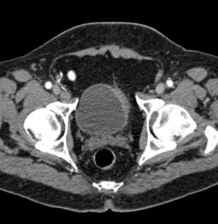 Bladder Cancer Left Bladder Wall - CTisus CT Scan