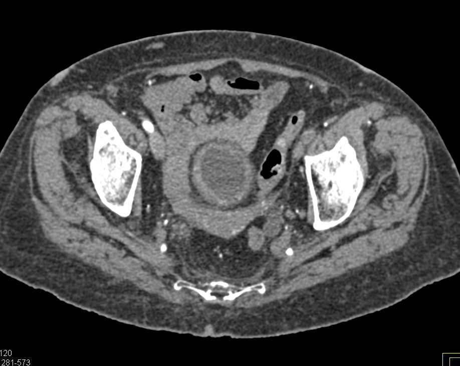 Diffuse Bladder Wall Carcinoma - CTisus CT Scan