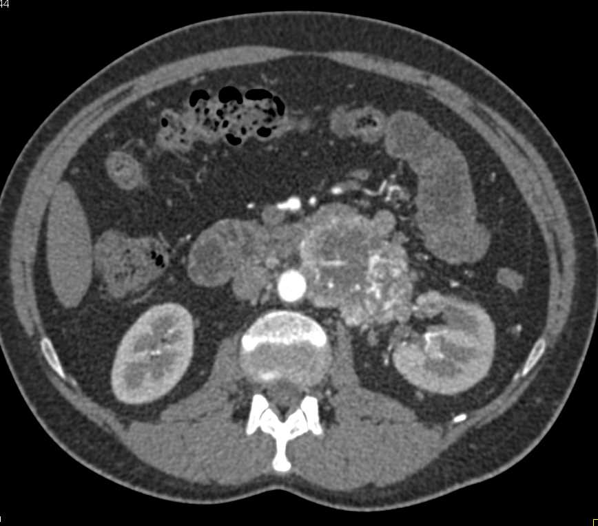 Paraganglioma Invades the Left Renal Vein - CTisus CT Scan