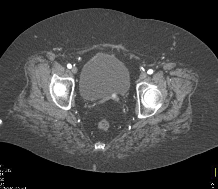 Renal Cell Carcinoma Metastatic to  the Left Prostate Gland - CTisus CT Scan