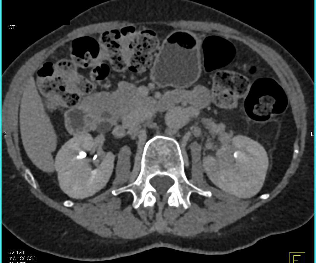 Multifocal Transitional Cell Carcinoma in Left Renal Pelvis and Bladder - CTisus CT Scan