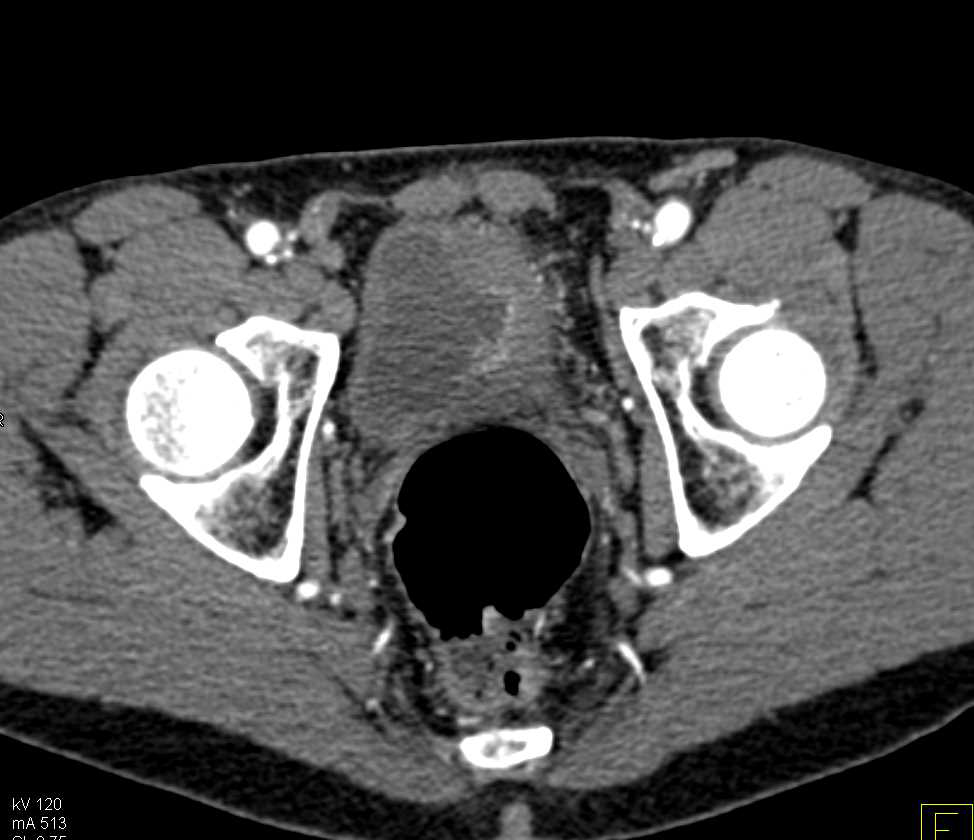 Bladder Cancer Left Wall of the Bladder - CTisus CT Scan