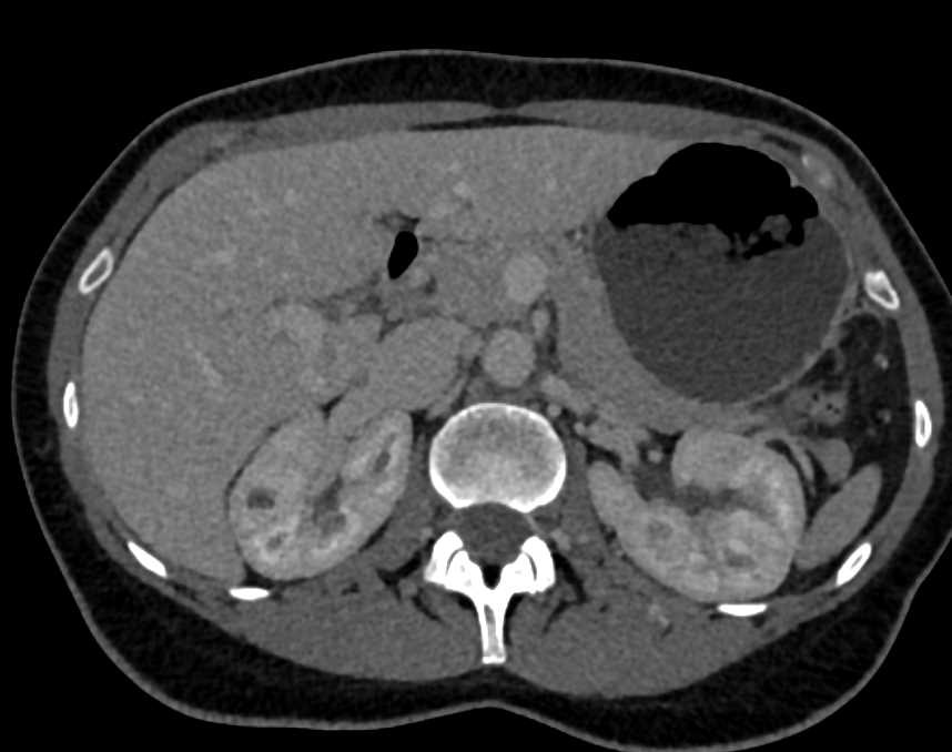 CT Urogram with Irregular Left Ureter due to Early Transitional Cell Cancer (TCC) - CTisus CT Scan