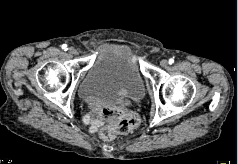 What Does Bladder Cancer Look Like On A Ct Scan Ct Scan