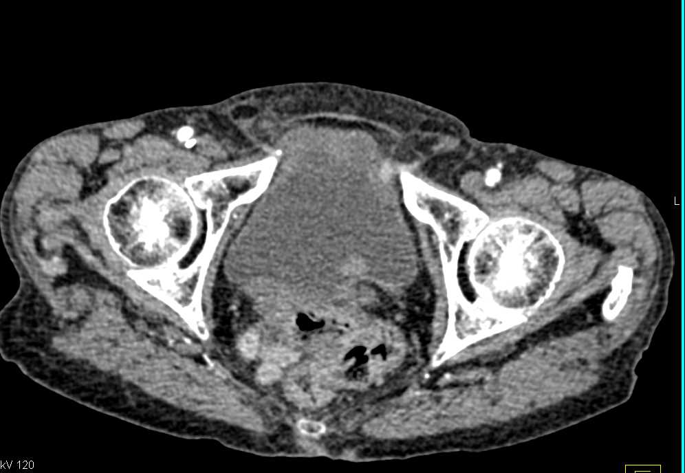 Subtle Incidental Bladder Cancer - CTisus CT Scan