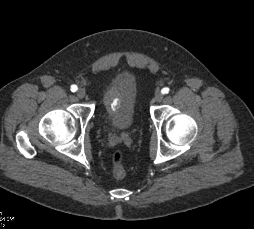 Bladder Cancer with Calcifications - CTisus CT Scan