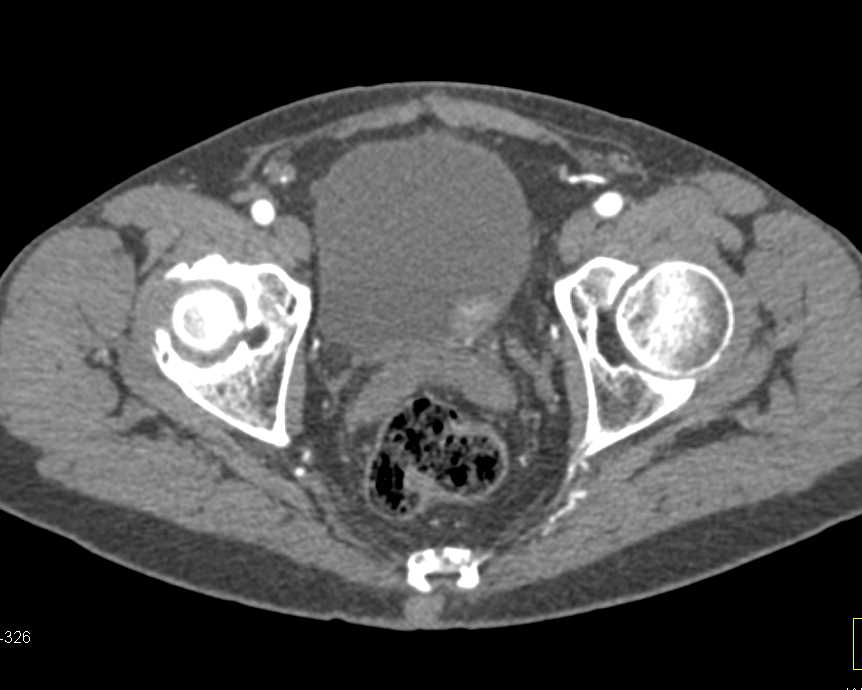 Incidental Bladder Cancer Seen on Arterial and Delayed Phase Imaging - CTisus CT Scan