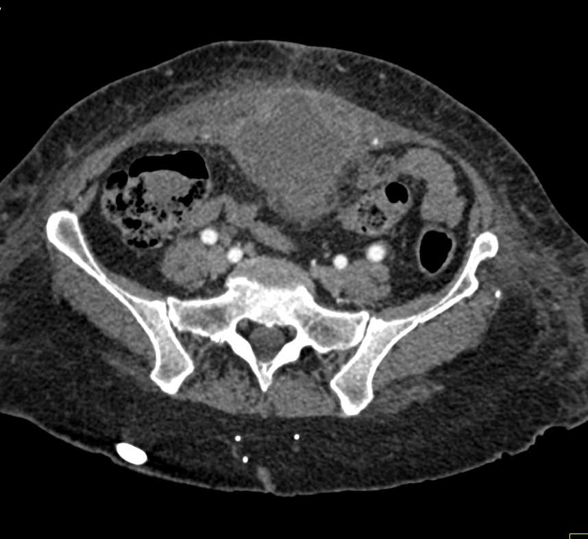 Urachal Carcinoma with Adenopathy - CTisus CT Scan