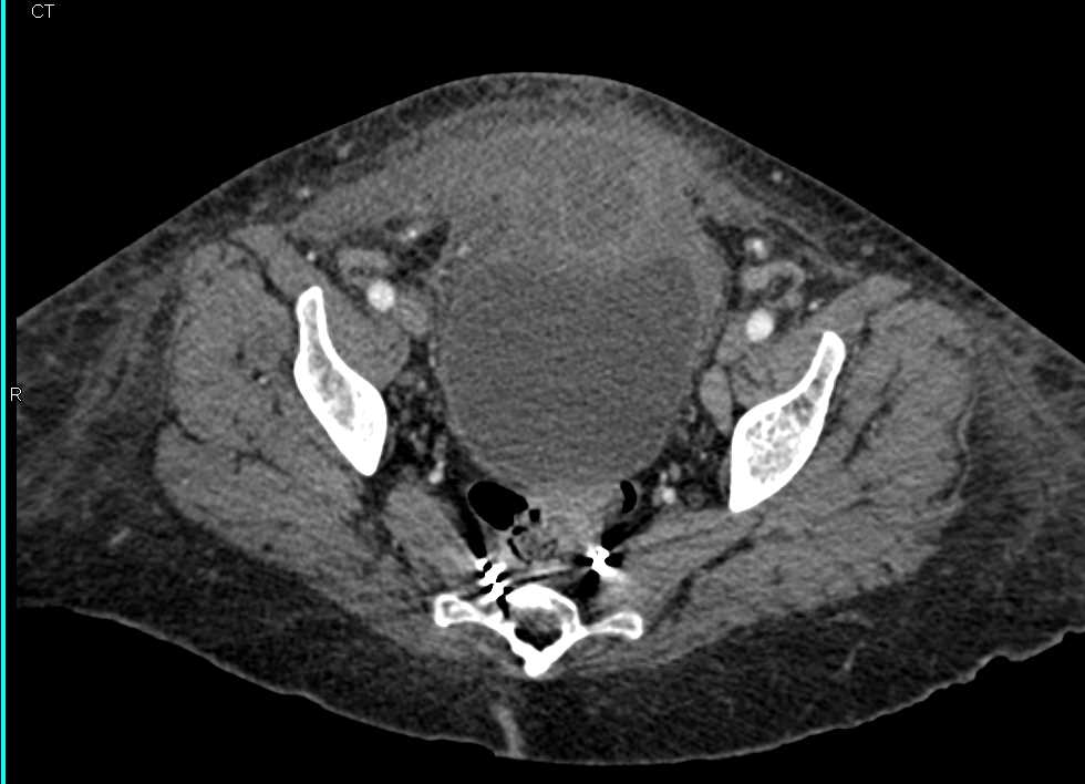 Urachal Carcinoma with Adenopathy - CTisus CT Scan