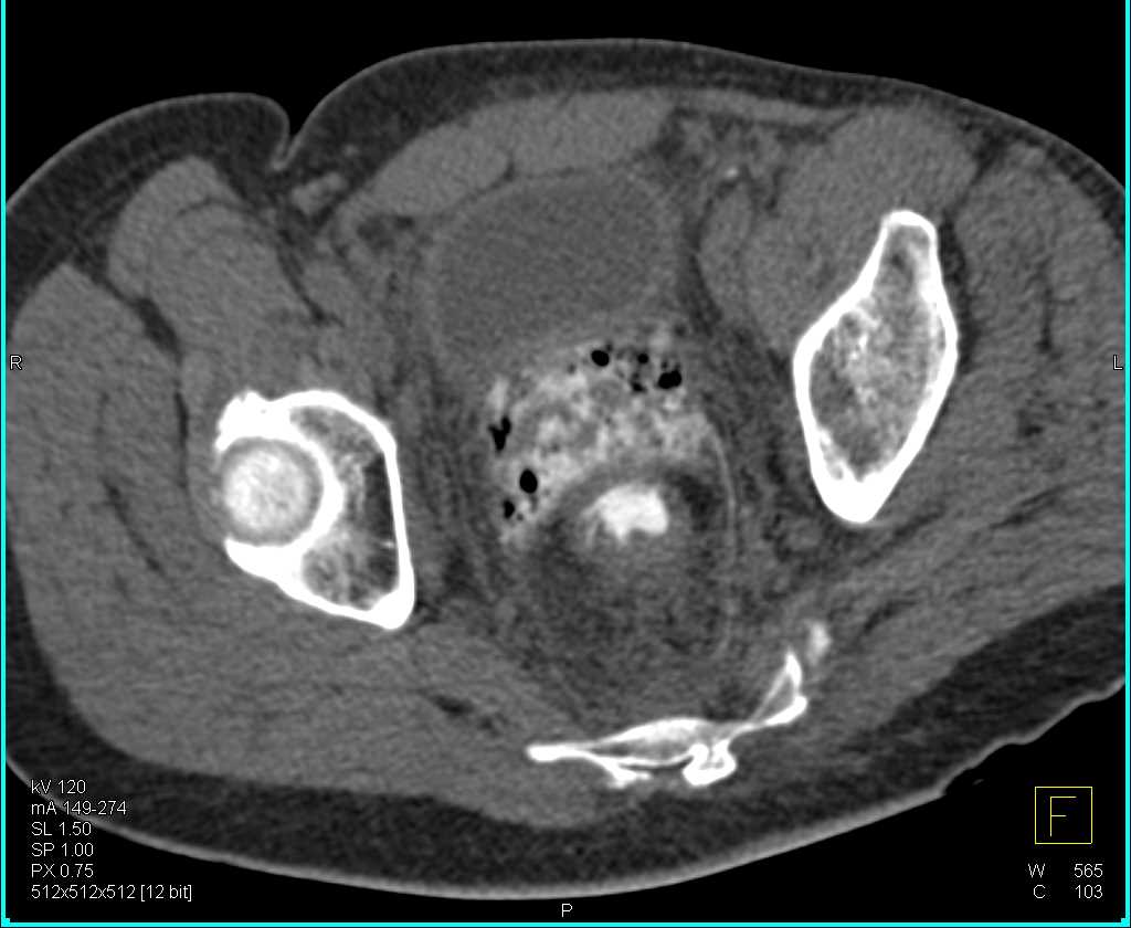 Fistulae from the Rectum to the Vagina - CTisus CT Scan