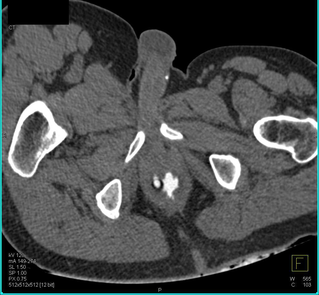 Fistulae from the Rectum to the Vagina - CTisus CT Scan