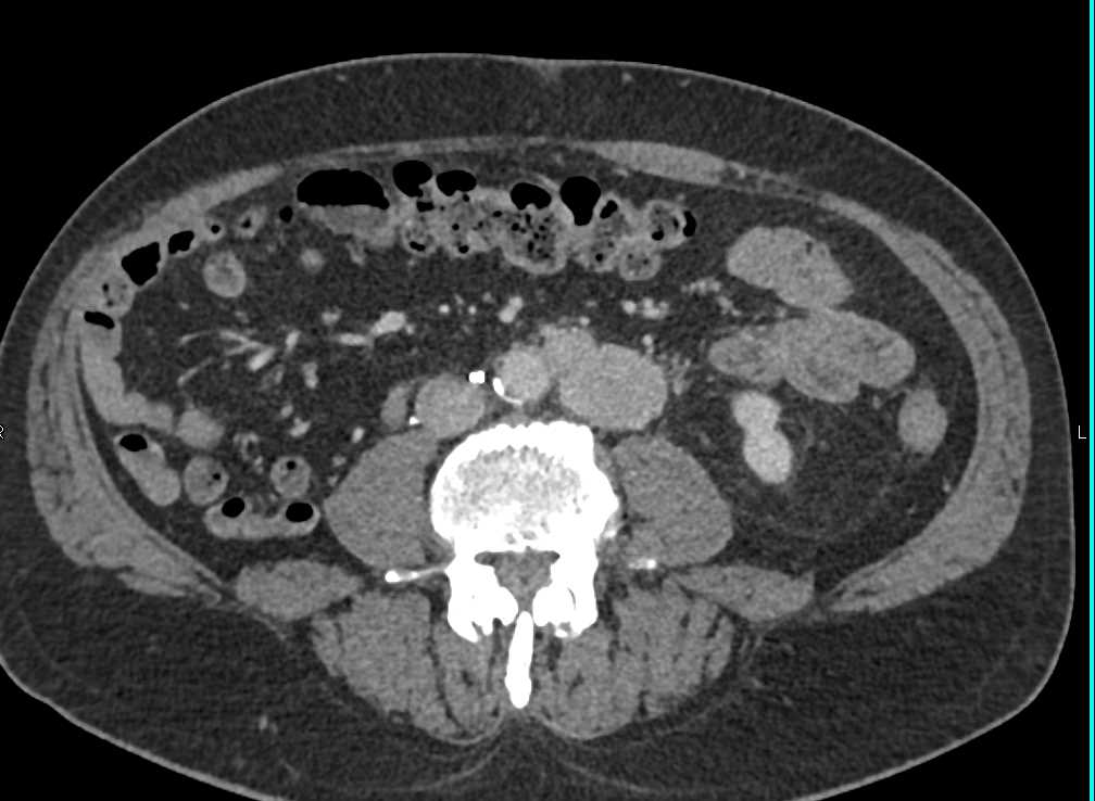 Recurrent Renal Cell Carcinoma with Adenopathy in the Chest and Abdomen - CTisus CT Scan