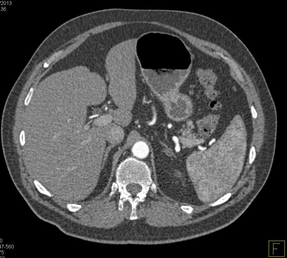 Pheochromocytoma in the Bladder Looks Like a Typical Transitional Cell Cancer (TCC) - CTisus CT Scan