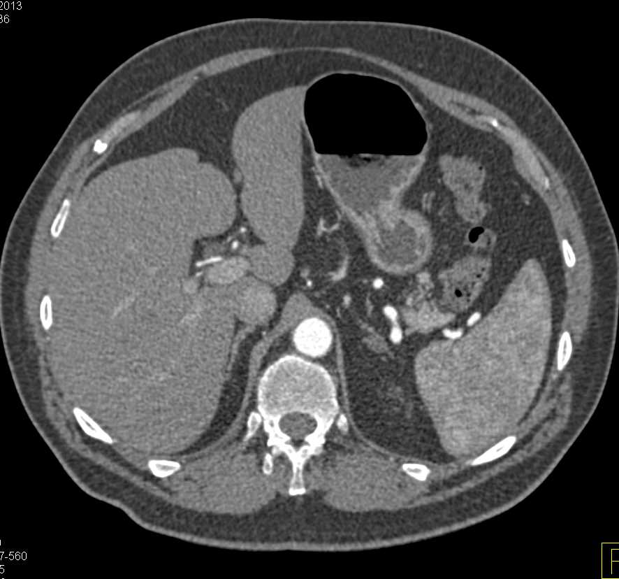 Pheochromocytoma in the Bladder Looks Like a Typical Transitional Cell Cancer (TCC) - CTisus CT Scan