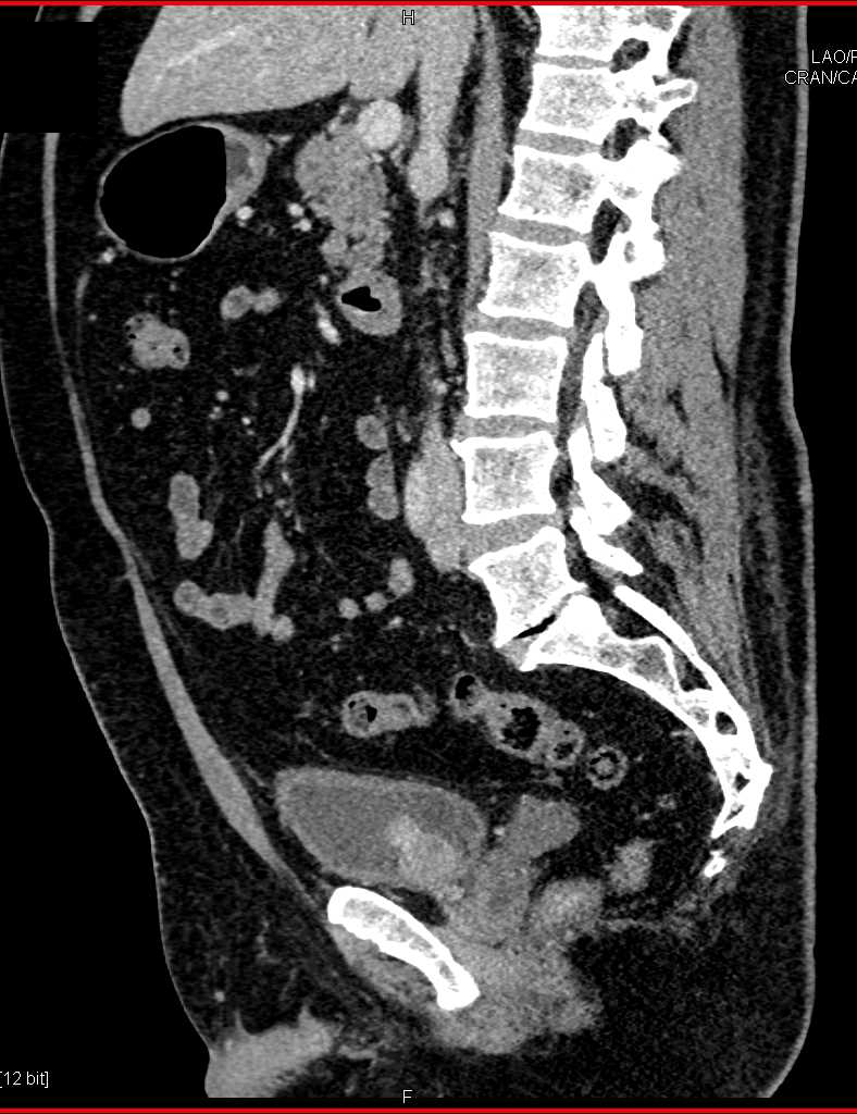 Pheochromocytoma in the Bladder Looks Like a Typical Transitional Cell Cancer (TCC) - CTisus CT Scan