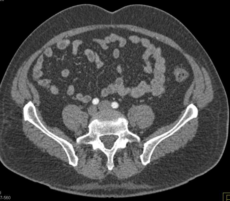 Pheochromocytoma in the Bladder Looks Like a Typical Transitional Cell Cancer (TCC) - CTisus CT Scan