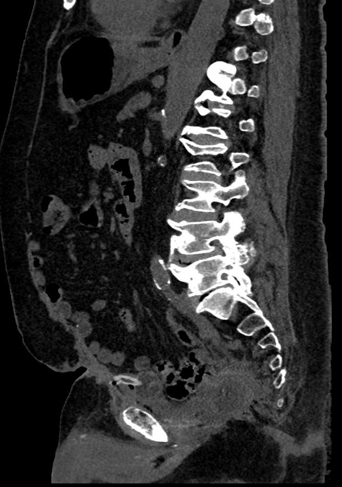 CT Cystogram with Recto-Vesicle Fistulae - CTisus CT Scan