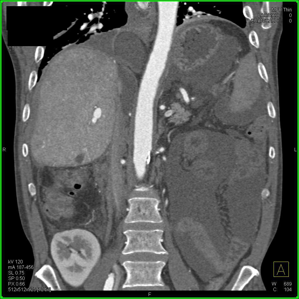 Pseudomembranous Colitis (PMC) in a Renal Transplant Patient with Ascites - CTisus CT Scan