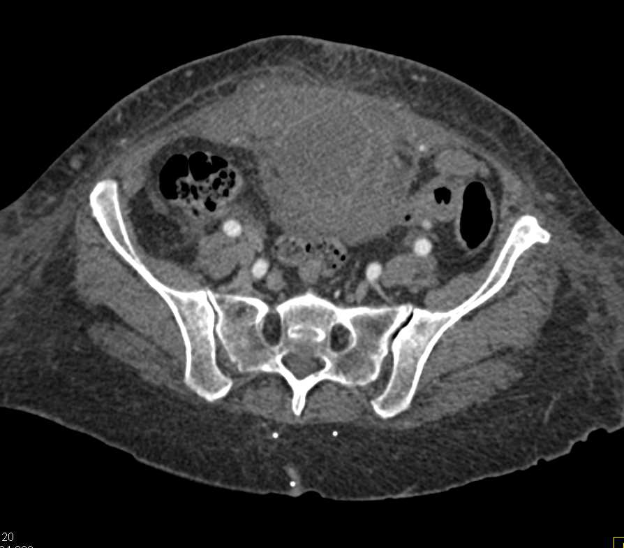 Carcinoma of the Urachus with an Abscess - CTisus CT Scan